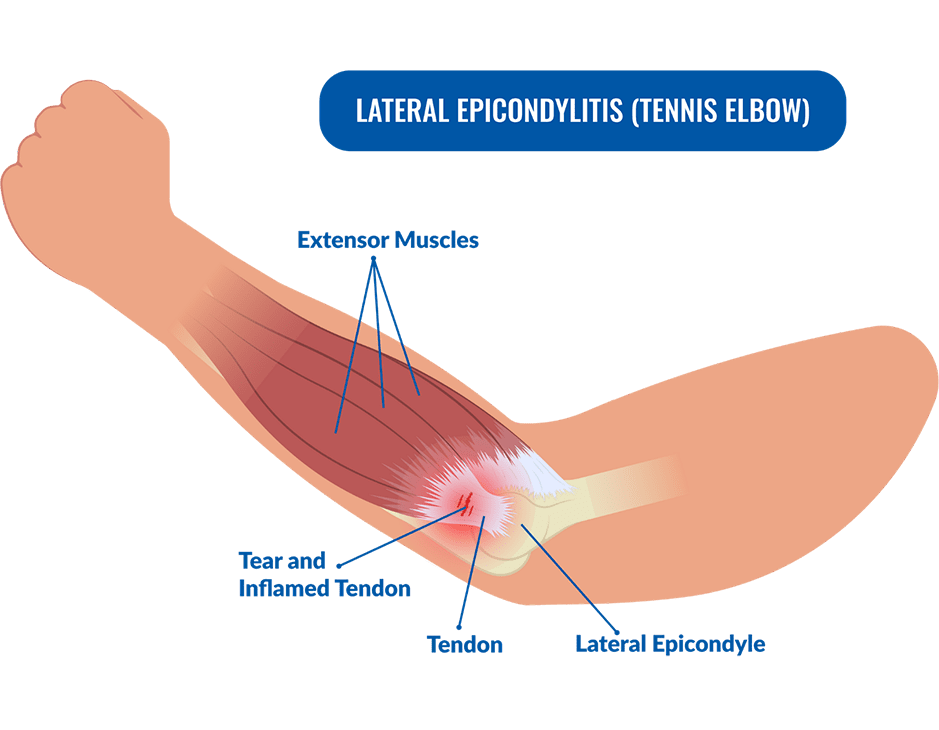 What Muscles Does Pickleball Work? Full Body Benefits Explained What Muscles Does Pickleball Work? Full Body Benefits Explained