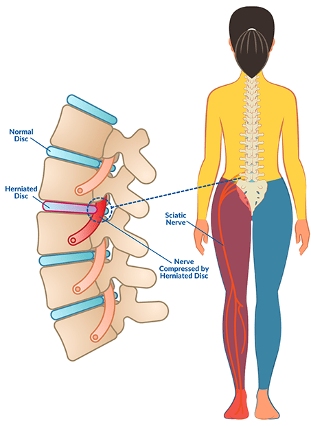 Normal spinal disc versus herniated disc